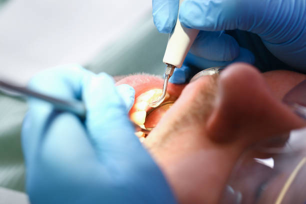 Best Urgent Care for Lost Fillings or Crowns in Ladera, CA